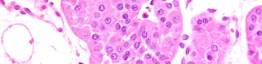 d, Vese onkocitóma: kisebb nagyobb sejtfészkekben