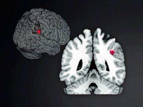 Gyrus