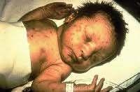 DIREKT TERJEDÉSI MECHANIZMUSOK II. PERINATÁLIS: INTRAUTERIN ÚTON - DIAPLACENTÁRISAN CONGENITÁLIS INFEKCIÓK (VELESZÜLETETT, AZ ANYAMÉHBEN SZERZETT) 1.