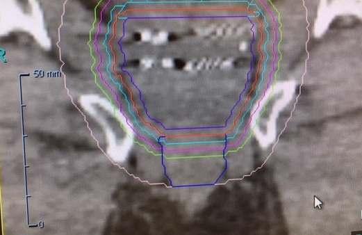 kontúr 3 mm -50 cm 3 CyberKnife, 4 gold