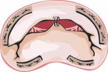 Billentyûmegtartó mûtétek A billentyû-endocarditis egyik lehetséges szövõdménye, hogy az amúgy kiváló állapotú ínhúrapparátus mellett a billentyû vitorlák egy pontján az endocarditises vegetáció