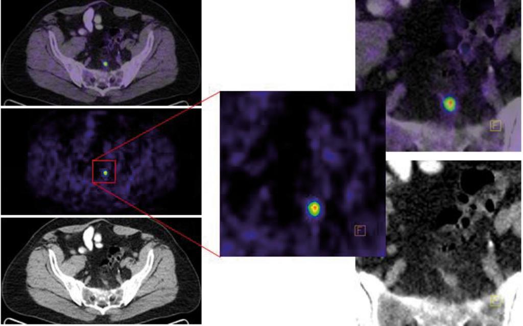 ÖSSZEFOGLALÓ KÖZLEMÉNY Kajáry Kornélia és mtsai 6. ábra III. indikációcsoport: tumor-recidíva kimutatása.