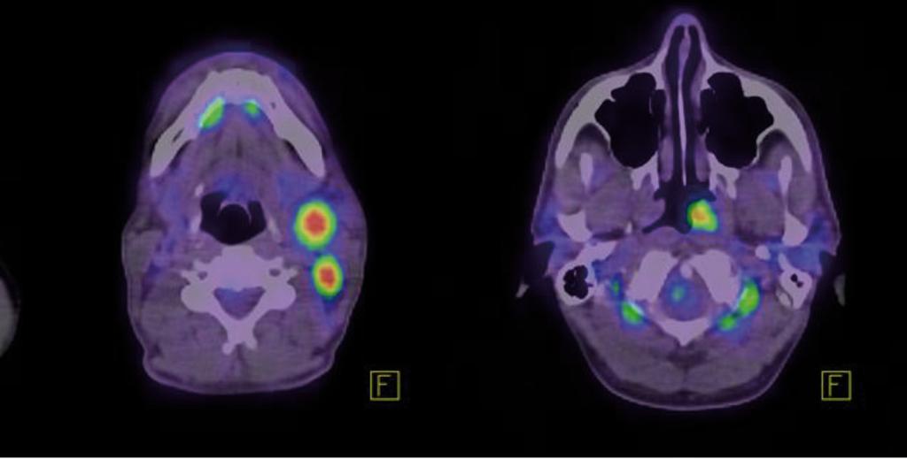 Bal oldalon fent axiális CT és lent axiális PET kép, míg középen axiális és jobb oldalon koronális fuzionált PET/CT