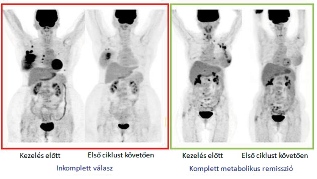 Bal oldalon fent CT és lent PET kép, míg jobb oldalon fuzionált PET/CT