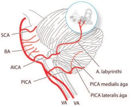 A neuritis vestibularis esetén a beteg a vegetatív panaszok miatt rosszul van, hányingertől szenved, a vizsgálat során hányhat is, de fel tud állni, és bizonytalanul ugyan, de néhány lépést segítség
