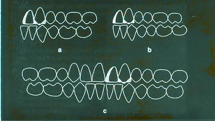 Kiegyenlítő extractio az antagonista fogsorban Orthodontiai