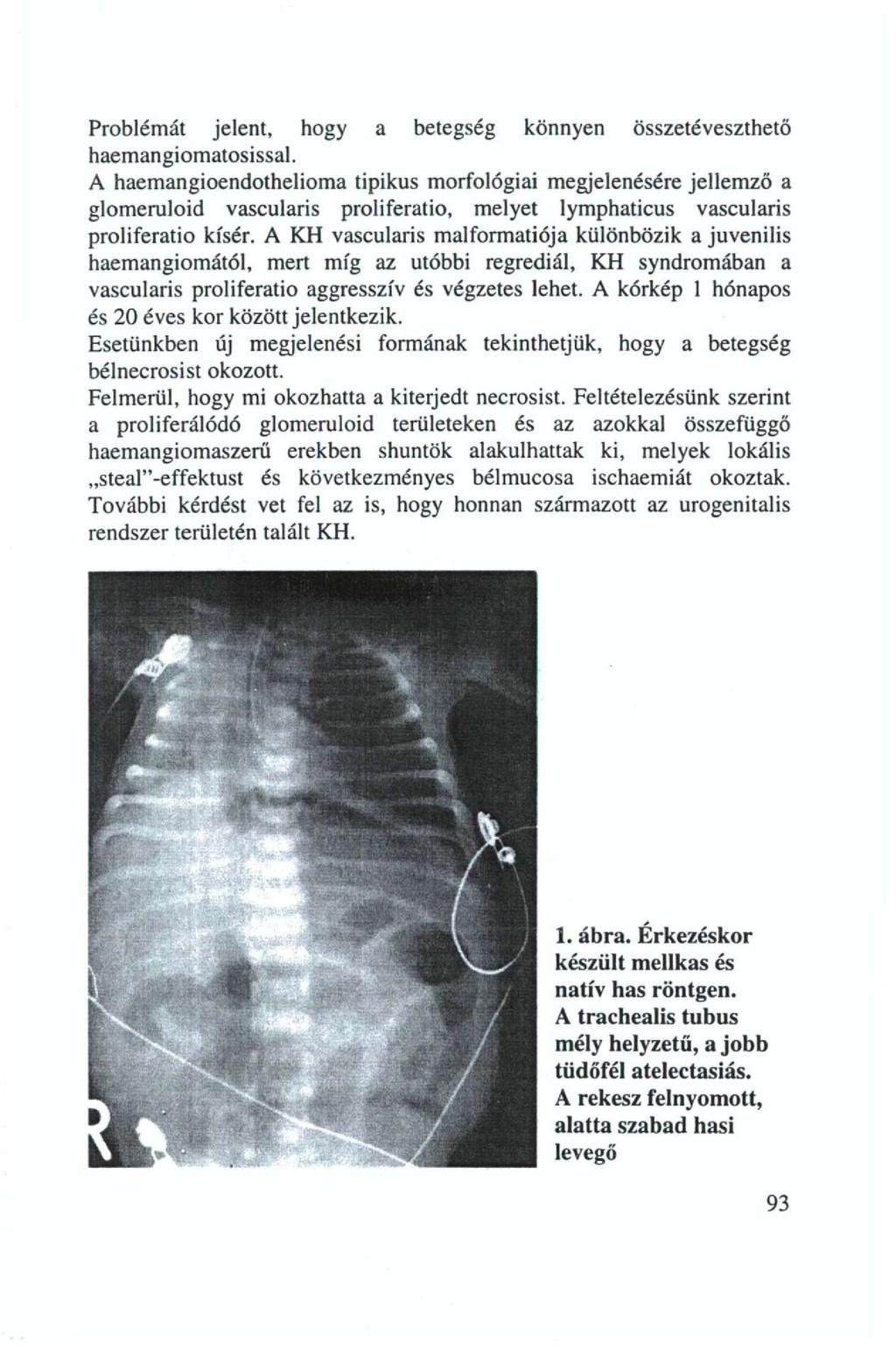 Prblémát jelent, hgy a betegség könnyen Összetéveszthető haemangimatsissal.