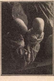 Keloidok hyperthyreosisos, illetve B asedow -kóros betegeken. 40 a. B. B.-né, 48 éves, hivatalnok neje. 1913 május 1.-én kisebb vaginalis mű téten esett át. Ugyanezen év október 10.