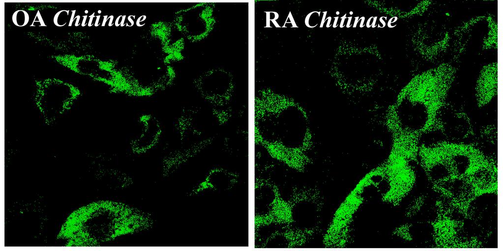 glükózaminidáz (NAG) aktivitását rheumatoid arthritises és