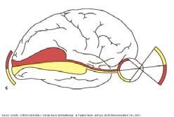 strke: CEREBROVASCULARIS STROKE-2010: Bal hmnym hemianpia : CV laesi: