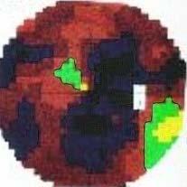 AMAUROSIS > ARTERIÁS keringési zavark (ather-thrmbsis, mikremblizáció) A papilla multiplex