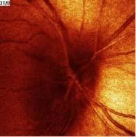 szemtünet - Ocularis Strke