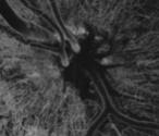 STROKE - OCULAR STROKE LÁTÁSVESZTÉS retina nervus pticus - látókéreg fgalmak -