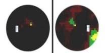 látásvesztés - fájdalmatlanul egy -/ kétszemes érintettség Fundus akut fázisban Fundus krónikus fázis Látótér akut fázisban Látótér