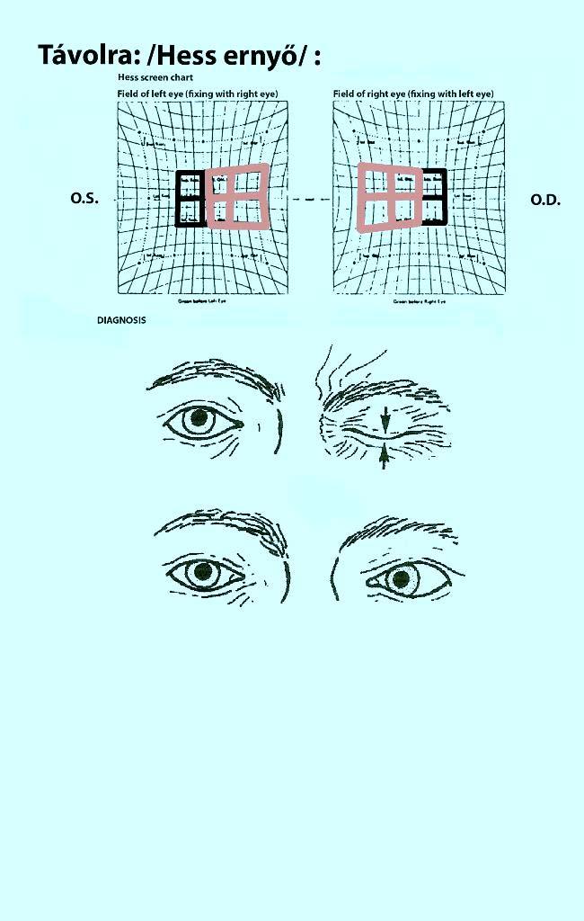 A perifériás abducens (n.vi.