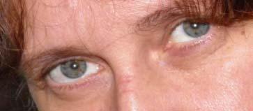 Az agytörzsi HORIZONTO (cycl)vertikális szemmzgászavar ún. OCULARIS TILT szindróma (OTR) Vestibul-Ocularis reflexpálya (VOR) FIV, vestibularis magvak, culmtrius szm.magvak, riflm, nucl. int.