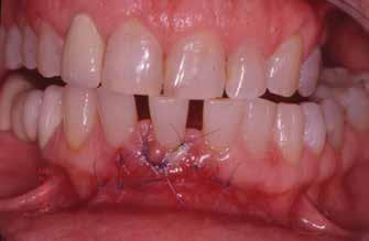 Bár a szájhigiénia nem volt tökéletes, approximálisan vékony supragingivális fogkövet regisztráltunk, 2012-ben a gingiva színe halvány rózsaszín, a korono-apikális szélessége 8 mm, az