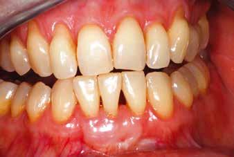 J Clin Periodontol. 2008; 35: 263 269. 2. Baldi C, Pini-Prato G, Pagliaro U, Nieri M, Saletta D, Muzzi L, Cortellini P: Coronally advanced flap procedure for root coverage.