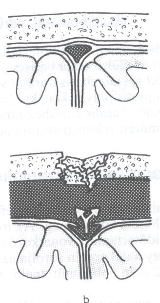 HAEMATOMA