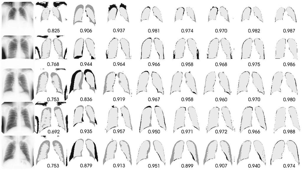 Tüdőszegmentálás eredeti kép szegmentálás 7 különböző eljárással összehasonlítás valódi