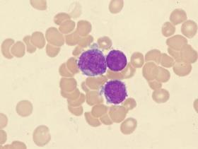 Vérkép Nem differenciált fehérvérsejtek (gyorsan osztódó, funkcióképtelen alakok = lymphoblastok) csontvelőben elfoglalják a