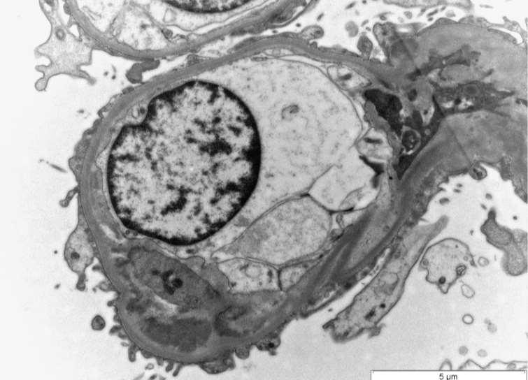 D D Mesangiálisan és subendotheliálisan elhelyezkedő elektrondenz depositumok (D) a glomeruláris kapilláris