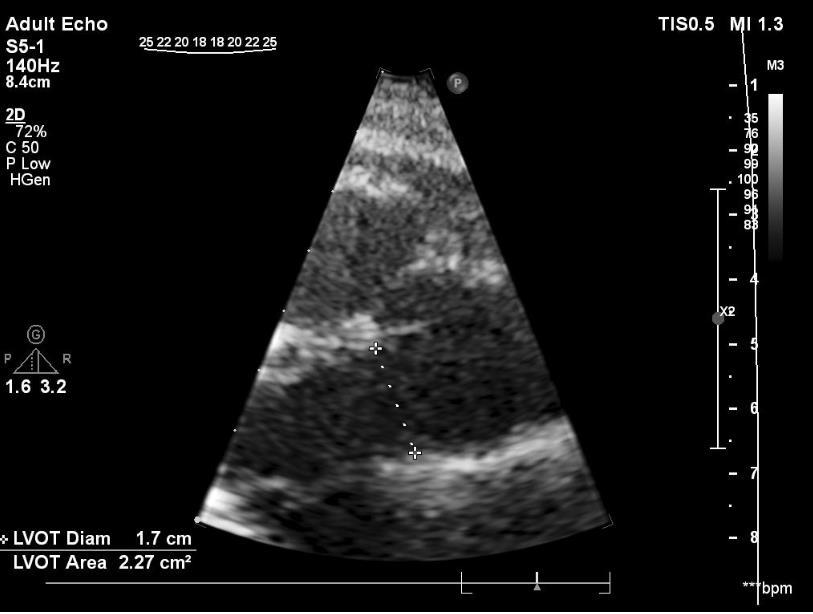 Stroke volumen meghatározás LVOT D (bal kamra kifolyó traktus átmérője) LVOT
