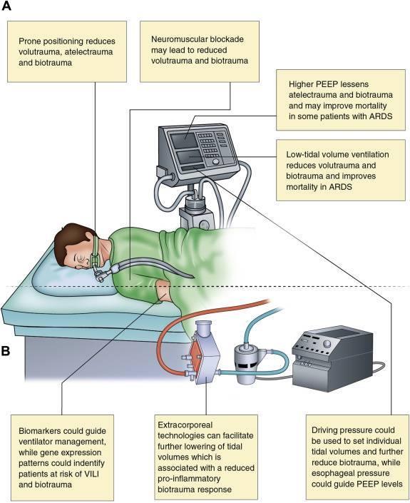 TP < 25 H 2 Ocm Peos mérése Paw < 15 H 2 Ocm EtCO 2 = 35-45 Hgmm FiO 2 < 50 % Hypoxia (SpO 2 < 96%) esetén: FiO