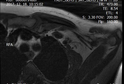 Sternoclaviculáris (SC) ficamok Mechanismus: indirekt (presternális diszlokáció) direkt