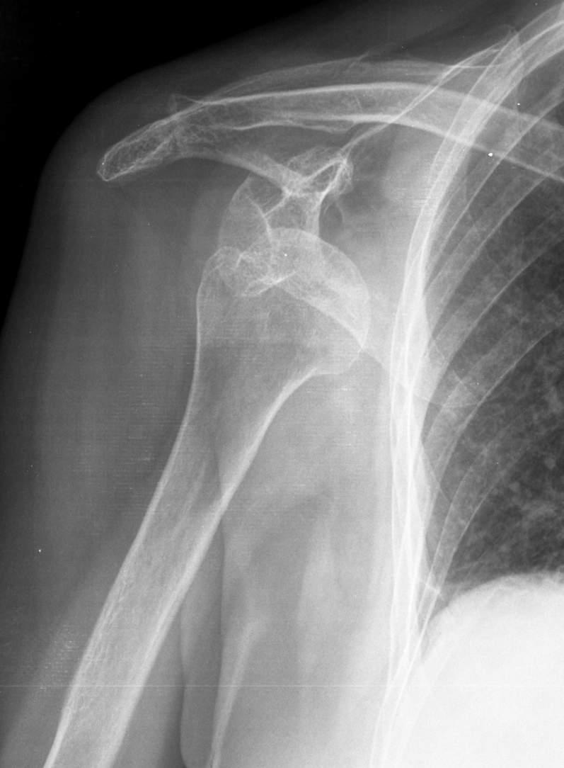 Elülső vállficam Traumás eredetű Veleszületett (Congenitális