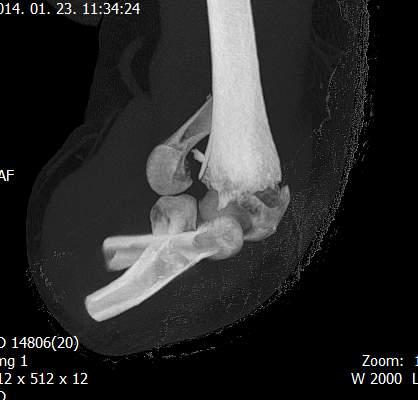 humerus