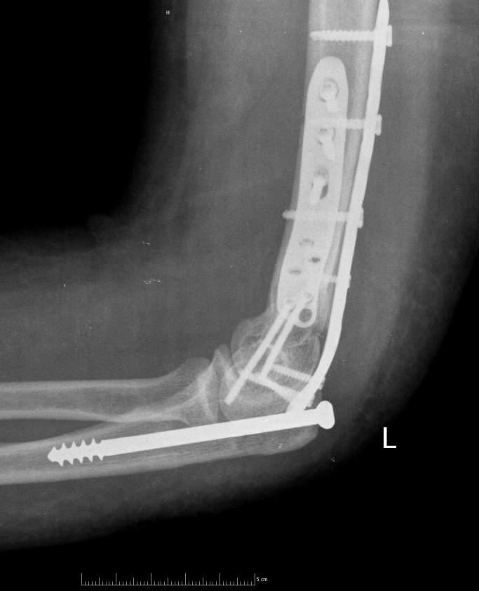 humerus törés gyógytorna)