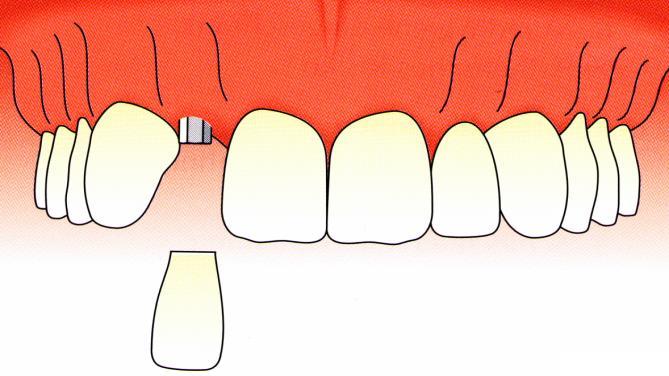 EGY FOG HIÁNYA IMPLANTÁCIÓS PROTETIKAI ELLÁTÁS AZONNALI IMPLANTÁCIÓ ÁLTALÁBAN A FELSŐ FRONTFOGAKNÁL, A PÁCIENS KORA, A BEAVATKOZÁS VAGY A TRAUMA NAGYSÁGA, AZ