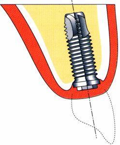 IMPLANTÁCIÓS