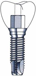 KEDVEZŐ LEHET BUKKO-LINGVÁLISAN 6 mm