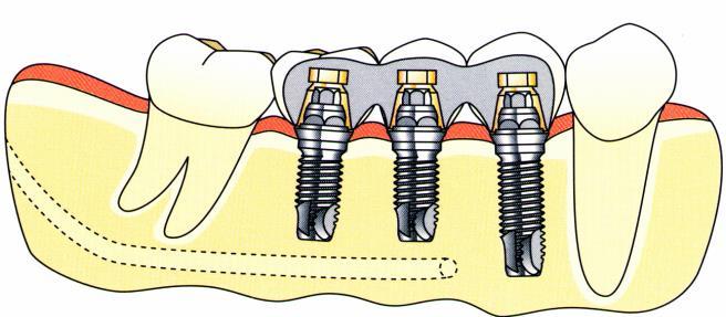 SORKÖZI HIÁNYOK IMPLANTÁCIÓS