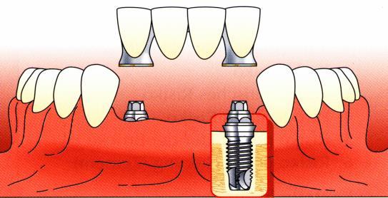 NÉGYTAGÚ, CSAK IMPLANTÁTUMON