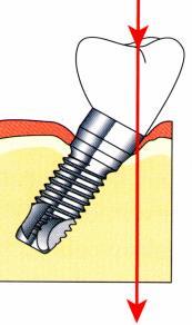 IMPLANTÁTUMOK