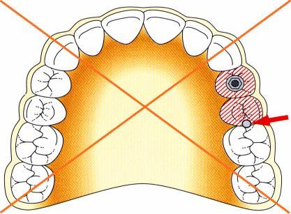 SORKÖZI HIÁNYOK A FELSŐ OLDALSÓ FOGAK TERÜLETE: LEHETŐLEG FOGANKÉNT 1 DB IMPLANTÁTUM, NEM KÖTJÜK ÖSSZE A TERMÉSZETES FOGAKKAL, A SIN. MAXILL.