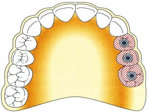 SORVÉGI FOGHIÁNYOK CSAK IMPLANTÁTUMRA MEGTÁMASZTOTT ÉS ELHORGONYZOTT RÖGZÍTETT FOGPÓTLÁS (HÍD) ELŐNYE: NEM KELL TERMÉSZETES