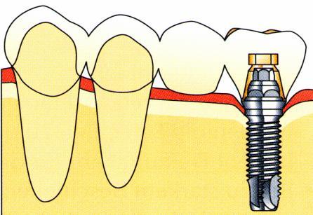 SORVÉGI FOGHIÁNYOK ELŐNYE: IMPLANTÁTUMRA