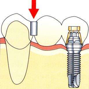 HÍD) KEVESEBB IMPLANTÁTUM SZÜKSÉGES A