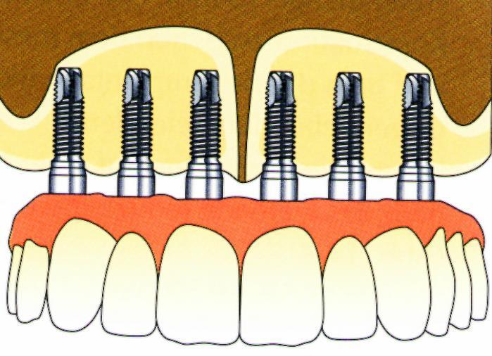 A TELJES FELSŐ FOGHIÁNYOK IMPLANTÁCIÓS PROTETIKAI MEGOLDÁSA IMPLANTÁTUMON ELHORGONYZOTT ÉS MEGTÁMASZTOTT RÖGZÍTETT FOGPÓTLÁS HÍD-PROTÉZIS, HIBRID-PROTÉZIS KÉSZÍTÉSE DEFINÍCIÓ: OLYAN, IMPLANTÁTUMOKRA