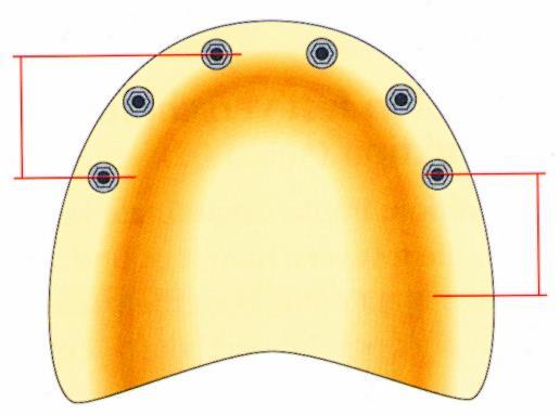 A TELJES FELSŐ FOGHIÁNYOK IMPLANTÁCIÓS PROTETIKAI MEGOLDÁSA AMIRE A TERVEZÉSNÉL GONDOLNI KELL: 1.