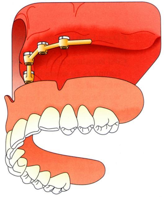 A TELJES FELSŐ FOGHIÁNYOK IMPLANTÁCIÓS PROTETIKAI MEGOLDÁSA IMPLANTÁTUMMAL ELHROGONYZOTT ÉS IMPLANTÁTUMON, IMPLANTÁTUMON ÉS NYÁLKAHÁRTYÁN, VAGY CSAK NYÁLKAHÁRTYÁN MEGTÁMASZTOTT OVERDENTURE KÉSZÍTÉSE