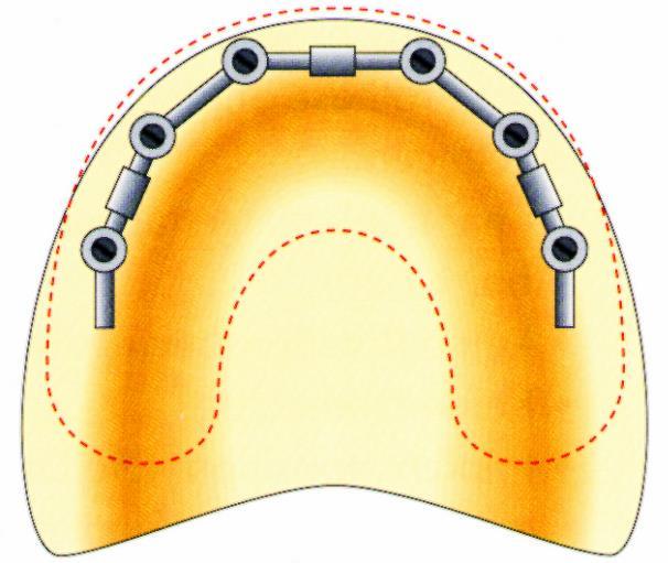 A TELJES FELSŐ FOGHIÁNYOK IMPLANTÁCIÓS PROTETIKAI MEGOLDÁSA IMPLANTÁTUMMAL