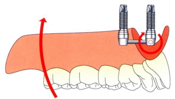 4 DB. IMPLANTÁTUM A FELSŐ FRONT RÉGIÓBAN 2.