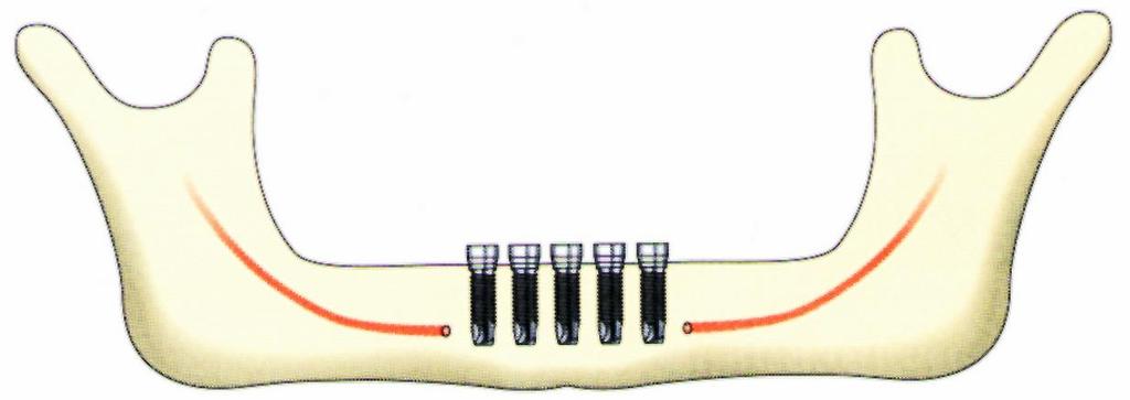 (HÍD-PROTÉZIS, HIBRID-PROTÉZIS) KÉSZÍTÉSE AZ IMPLANTÁTUMOK SZÁMA: 4 6