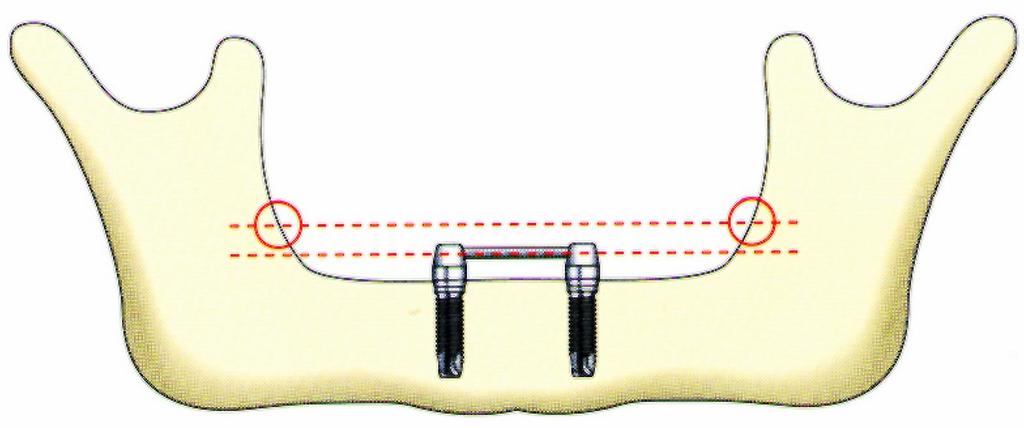 OVERDENTURE KÉSZÍTÉSE AMIRE A TERVEZÉSKOR GONDOLNI KELL: AZ IMPLANTÁTUMOK POZÍCIÓJA