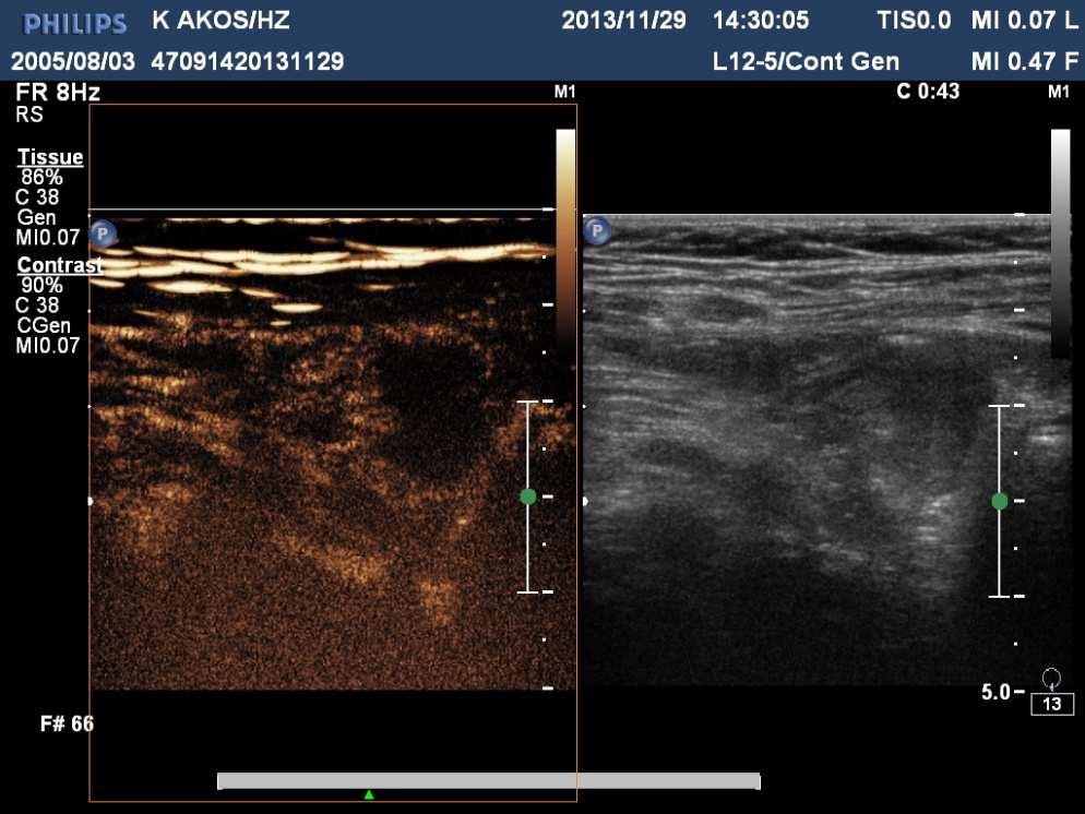 Bowel infection or GVH?